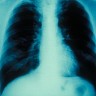 Tajanstvena upala pluća odnijela 30 života