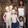 Crna Brazilka rodila troje bijele djece