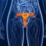 Osam tipova HPV-a najčešće odgovorno za rak maternice