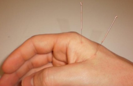 Akupunktura zbilja ublažava bol