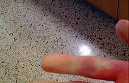 Raynaudov sindrom bijelih prstiju uslijed hladnoće