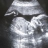Žensko dijete i dalje nije poželjno - raste ženski feticid
