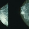 Lijekovi za prevenciju raka dojke i jajnika