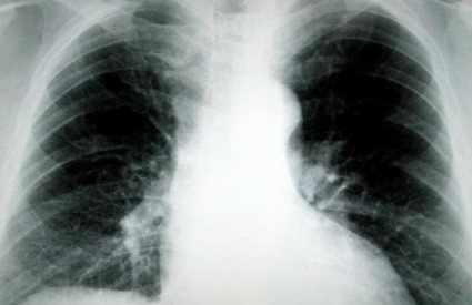 Rak pluća postat će izlječiv?