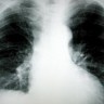 Lijek za rak pluća stiže za najviše godinu dana?