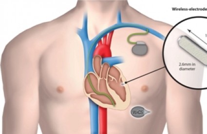 Bežični pacemaker skorašnje budućnosti
