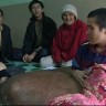 Liječnici Vijetnamcu izvadili tumor težak nevjerojatnih 90 kilograma