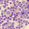Revolucionarno liječenje leukemije ubija stanice raka poput prehlade