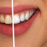 5 načina za prirodno izbjeljivanje zuba