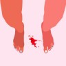 Točkasto krvarenje između menstruacija - kada se obratiti liječniku?