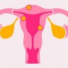 Znate li što je miom maternice i koji su simptomi?
