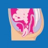 Što svaka žena treba znati o prolapsu zdjeličnih organa